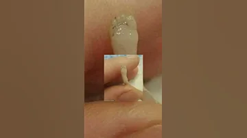 رفضت الام عملية الاجهاض و جت رسالة أن الجنين يكون مكتملا رغم صغر حجمه ووزنه 