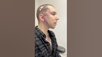 Why I Got A Face Lift & Neck Lift At 32 Years Old