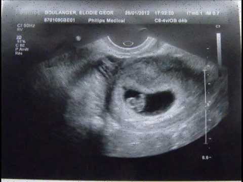 Echographie 11 semaine de grossesse