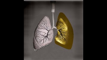 Tension Pneumothorax explained in 1 minute