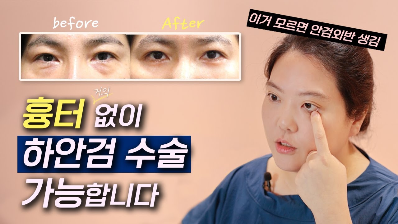 [하안검 흉터 안생기는 수술 노하우 전격 공개] 안검외반과 흉터때문에 하안검수술이 망설여진다면? - YouTube
