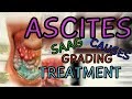 What are Ascites? Transudate vs Exudate - SAAG - Fluid Wave Test - Shifting Dullness -  Treatment