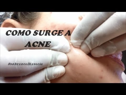 ACNE O QUE É  E COMO SURGE A ACNE / BACTÉRIA PROPIONIBACTERIUM ACNE