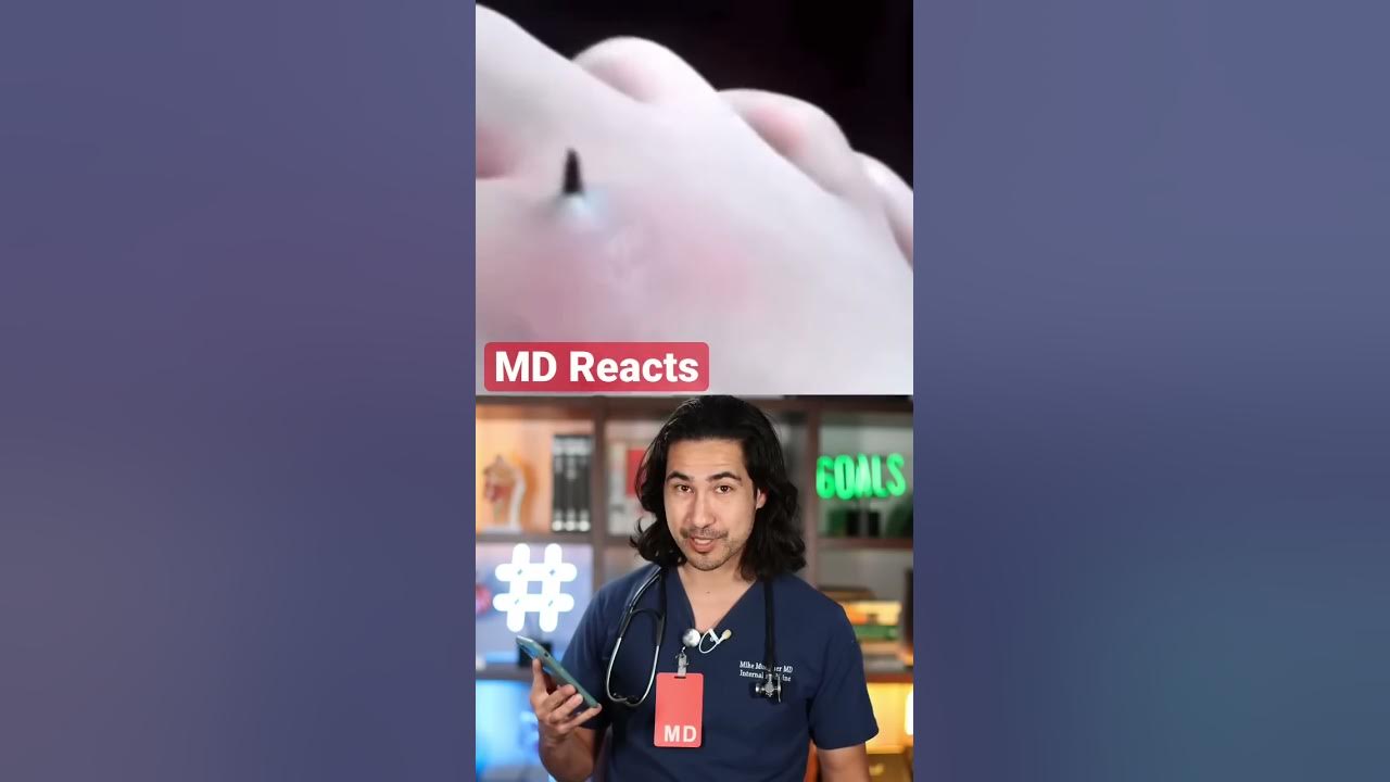 Wild Skin Tweezing! Doctor Reacts #skincare #ingrownhair #skin Wild Skin Tweezing! Doctor Reacts #skincare #ingrownhair #skin