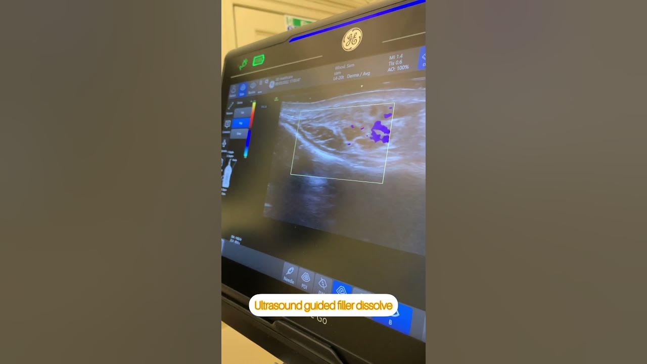 Ultrasound Guided Filler Dissolve YouTube ultrasound-guided-filler-dissolve-youtube