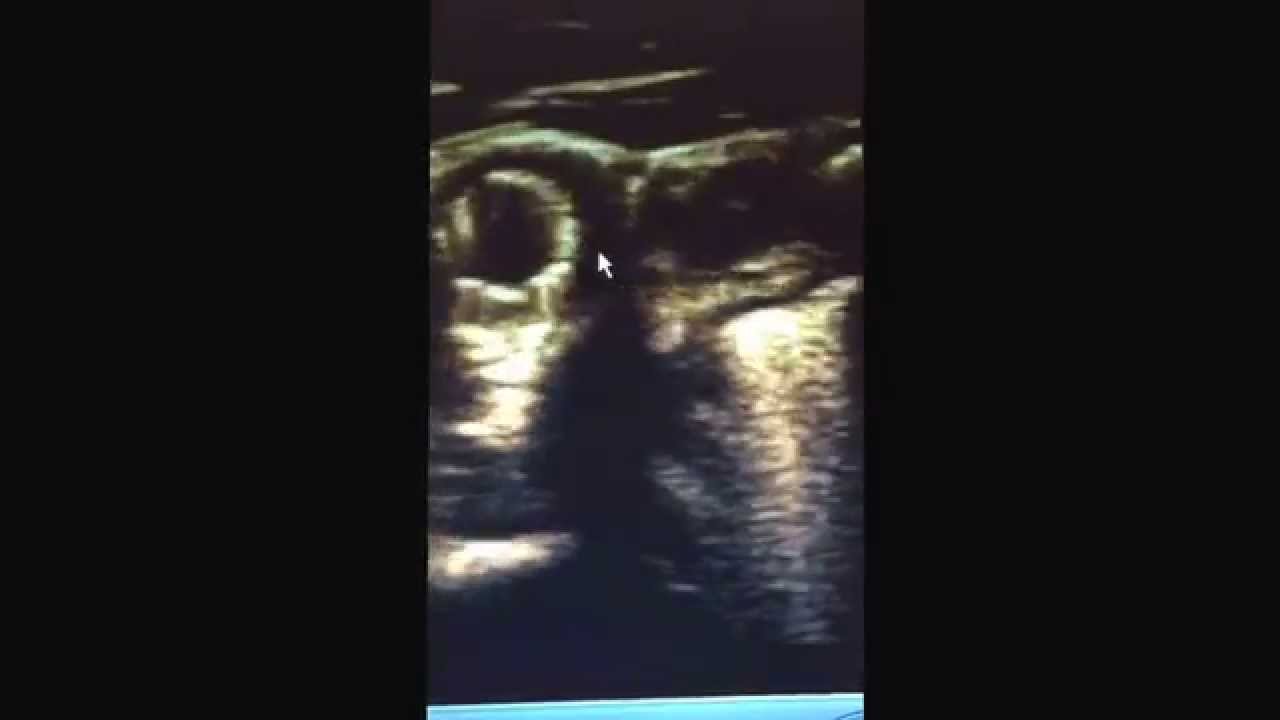 Resténose carotide interne post endartériectmoie suivie d'angioplastie camera iphone 8 plus apk