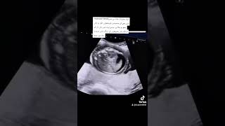 Fetal Hydrops #A Fluid is seen in fetal heart ,lungs ,skin.