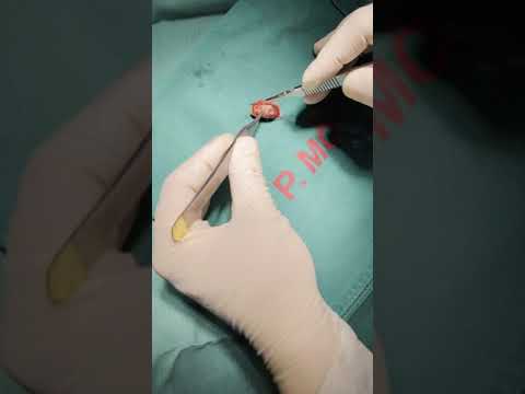 Video Bs Giang mổ u bã đậu cánh tay - youtube