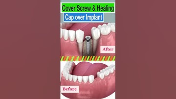 What Happens if My Healing Cap Comes Loose?