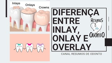 Explicando sobre inlay, onlay e overlay | Resumos de Odonto