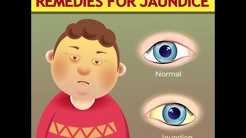 10 Effective Home Remedies for Jaundice