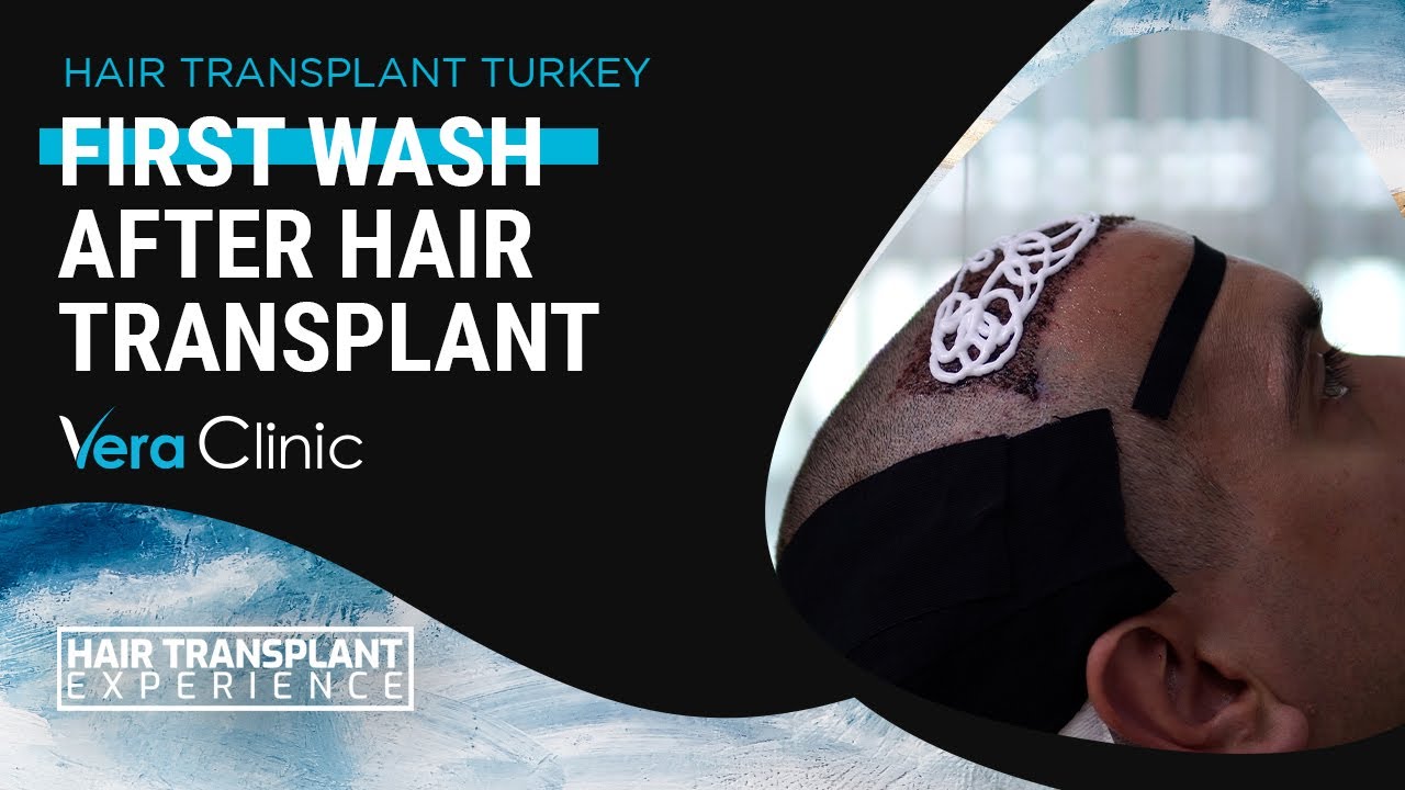 How to Do Your Hair Wash After 24 Hours of Hair Transplant? 