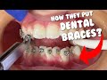 How they put braces - Dental Braces Tooth Time Family Dentistry New Braunfels