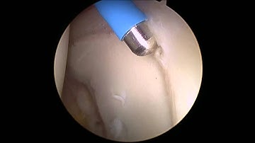 Hip Arthroscopy for Labral Tears - Debridement and Repair