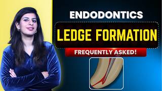 Dentistry 101 | Ledge formation | Conservative dentistry | Final year BDS | NEET MDS important