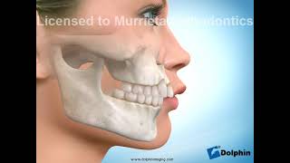 Murrieta Orthodontics first bicuspid extraction with favorable lip posture