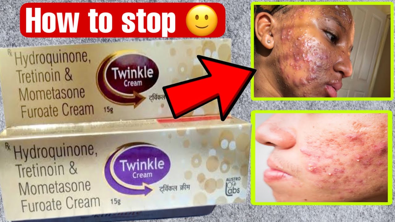 Twinkle  ko use karna kaise band kare | Twinkle cream के side effects kaise | fair soft skin