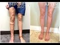 My Varicose Vein Story - All Your Questions Answered!