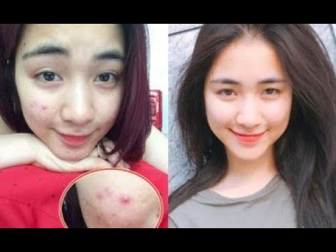 Hòa Minzy chỉ làm cách này mà mặt chi chít mụn qua một đêm da lại láng mịn sáng hồng