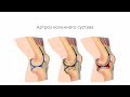 Артроз коленного сустава - симптомы, причины, диагностика