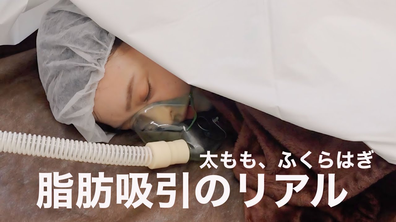 【脂肪吸引】辛すぎた。足の脂肪吸引のリアルです🔥