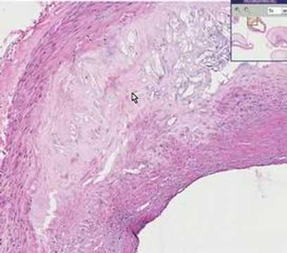 Artery atherosclerosis coronary Coronary Artery