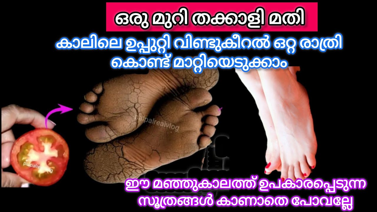 ഒരുമുറി തക്കാളി കൊണ്ട് കാലിലെ വിണ്ടുകീറൽ മാറ്റിയെടുക്കാം / Kitchen Hacks