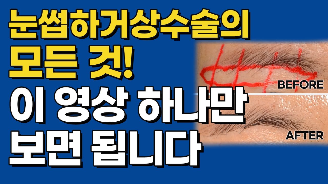 셀라성형외과★눈썹하거상수술의 모든 것!! 이 영상 하나만 보면 됩니다.[눈썹하거상수술 설명 통합편]