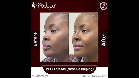 🥰✨PDO threads (Nose Reshaping) by New U Med Spa Orlando✨🥰