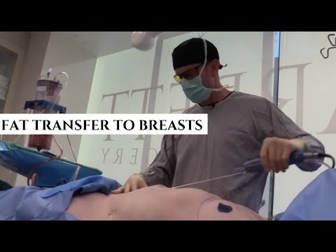 See Ciara's Amazing Transformation | Fat Transfer to Breast Augmentation | All Natural, No Implants!