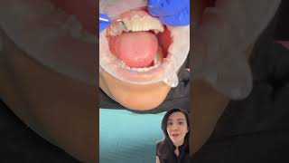 Temporary veneers!