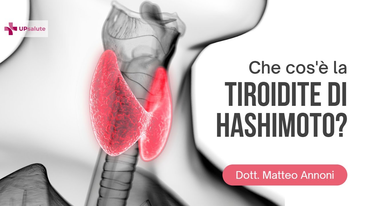 Tiroidite di Hashimoto - Dottore Matteo Annoni - UPsalute Channel