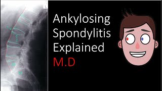 Ankylosing Spondylitis Explained