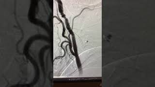 Carotid stenting of a soft plaque stenosis screenshot 3