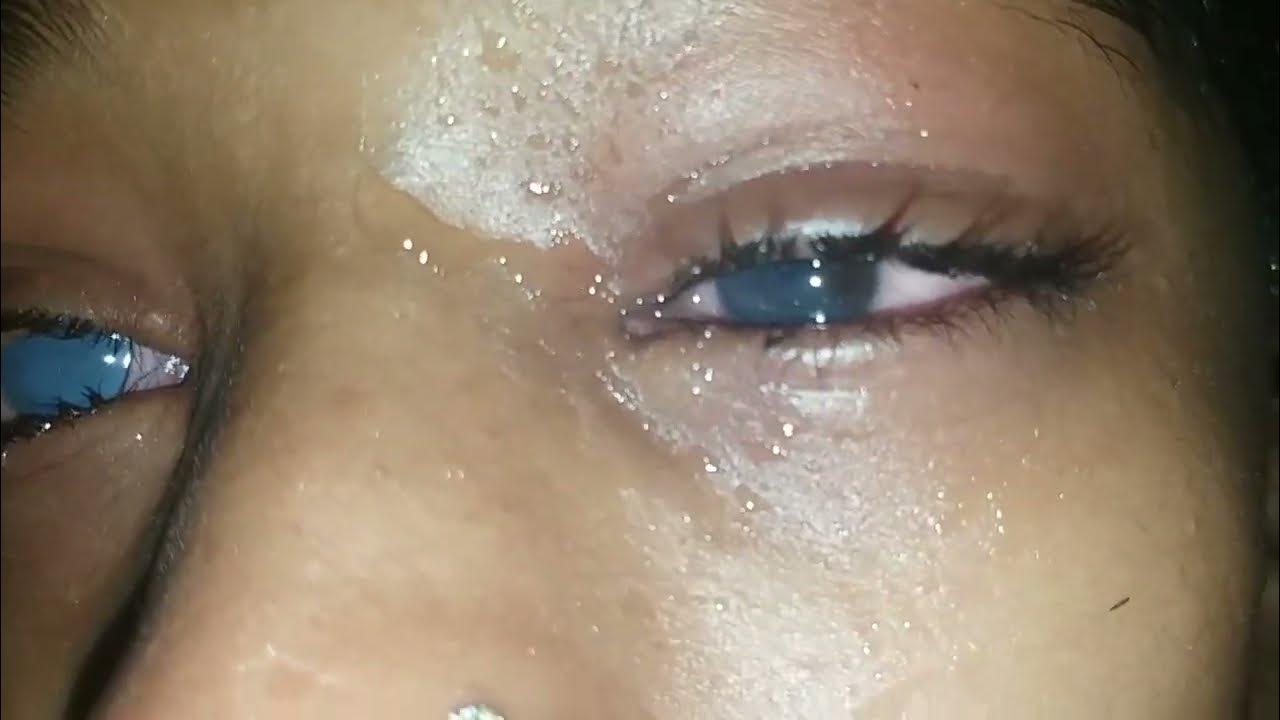 ACCIDENTAL ACID FALL ON EYE YouTube