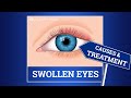 Swollen eyelid causes  treatment