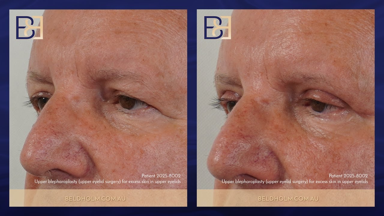 Upper Blepharoplasty (Upper Eyelid Surgery) for Excess Skin in Upper Eyelids (Patient 2025-8002)