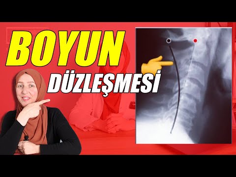 BOYUN DÜZLEŞMESİ EGZERSİZLERİ / BOYUN FITIĞI EGZERSİZLERİ /  Fzt. Aynur BAŞ BOYUN DÜZLEŞMESİ