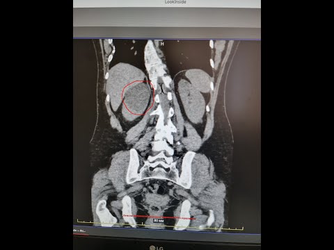 лапароскопическая резекция кисты почки