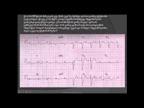 ეკგ- დილატაციური კარდიომიოპათია / dilataciuri kardiomipatia /ელექტროკარდიოგრამის გარჩევა