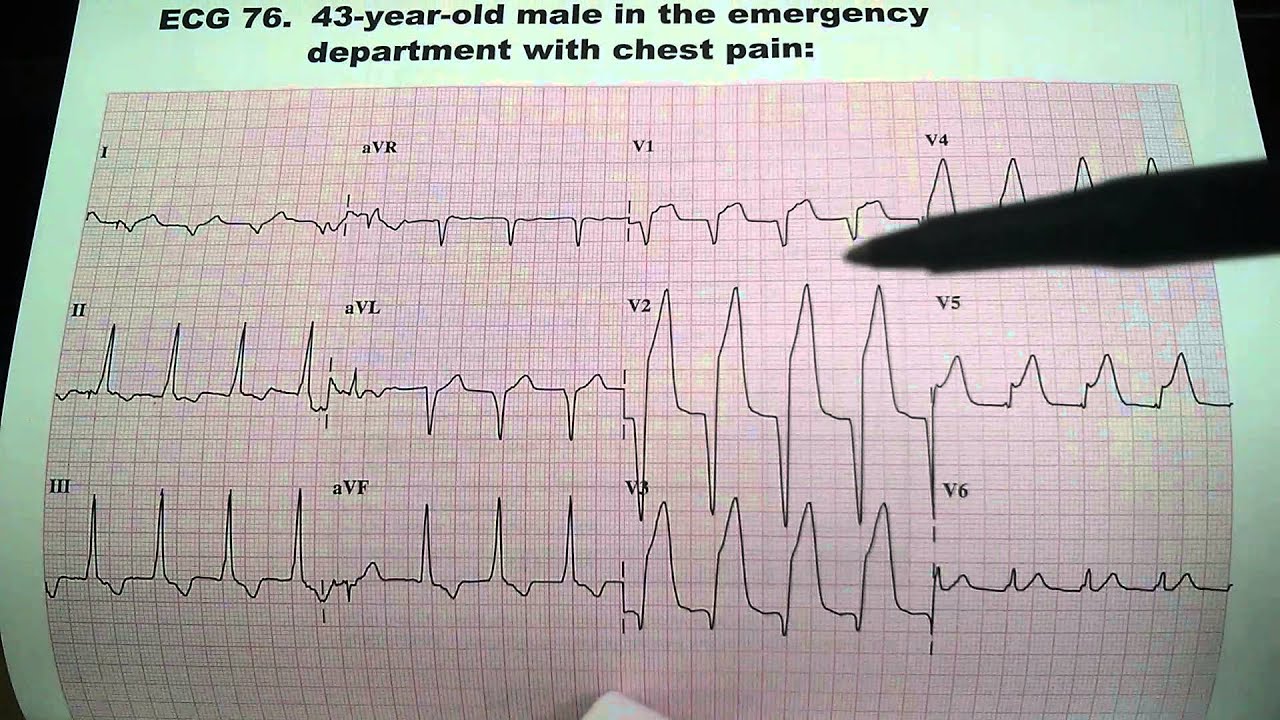 Chest Pain EKG ECG Electrocardiogram Dr. Ben Zur YouTube