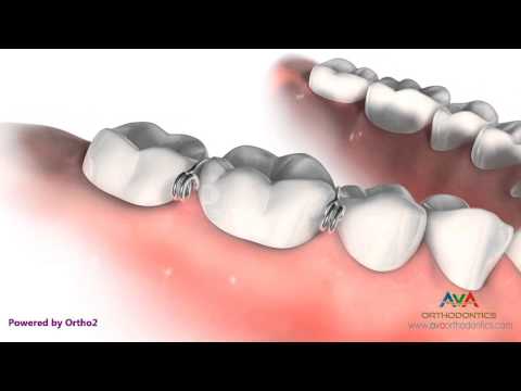 Orthodontic Separator or Spacer - Metal Helix