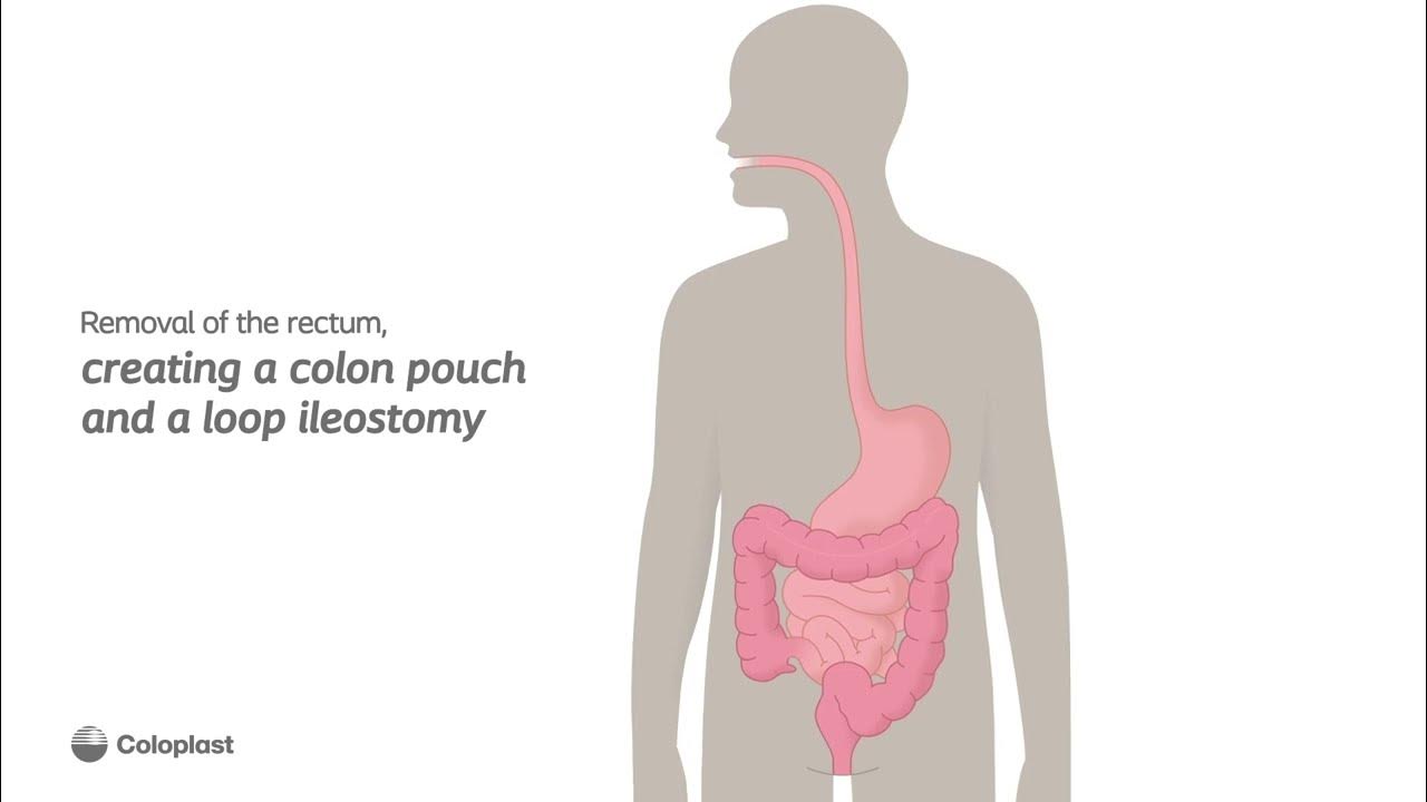 Coloplast Surgical Animation Ileostomy_Loop ileostomy and pouch with rectum removal YouTube