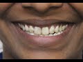 Do you hide your teeth due to Fluorosis?| Find out the best treatment by best cosmetic dentist. View