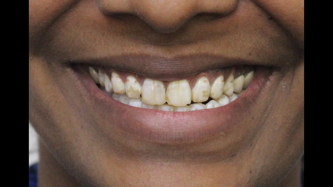 Do you hide your teeth due to Fluorosis?Find out the best treatment