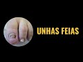 Unhas feias