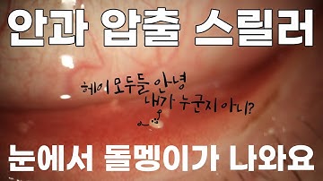 *약혐 주의* 피르가즘 급 결막결석 제거하기!