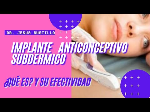 Como funciona el implante anticonceptivo