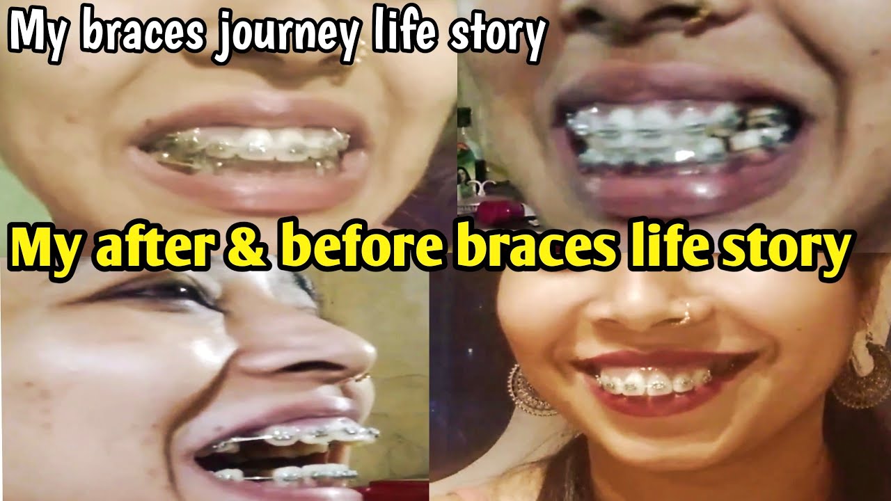 My Braces Life Story ll Braces Journey Story ll After and Before l orthodontics Video YouTube