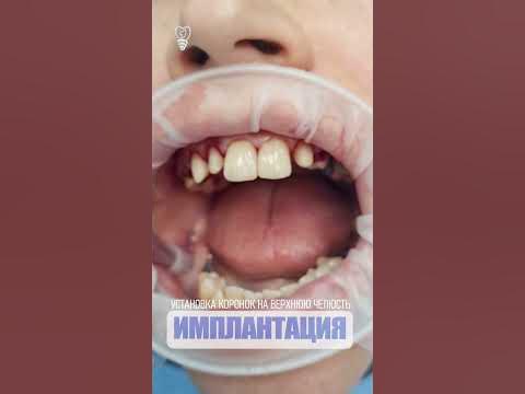 Установка зубных коронок. Installation of dental crowns #implantation ...